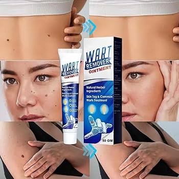 Wart Remover cream