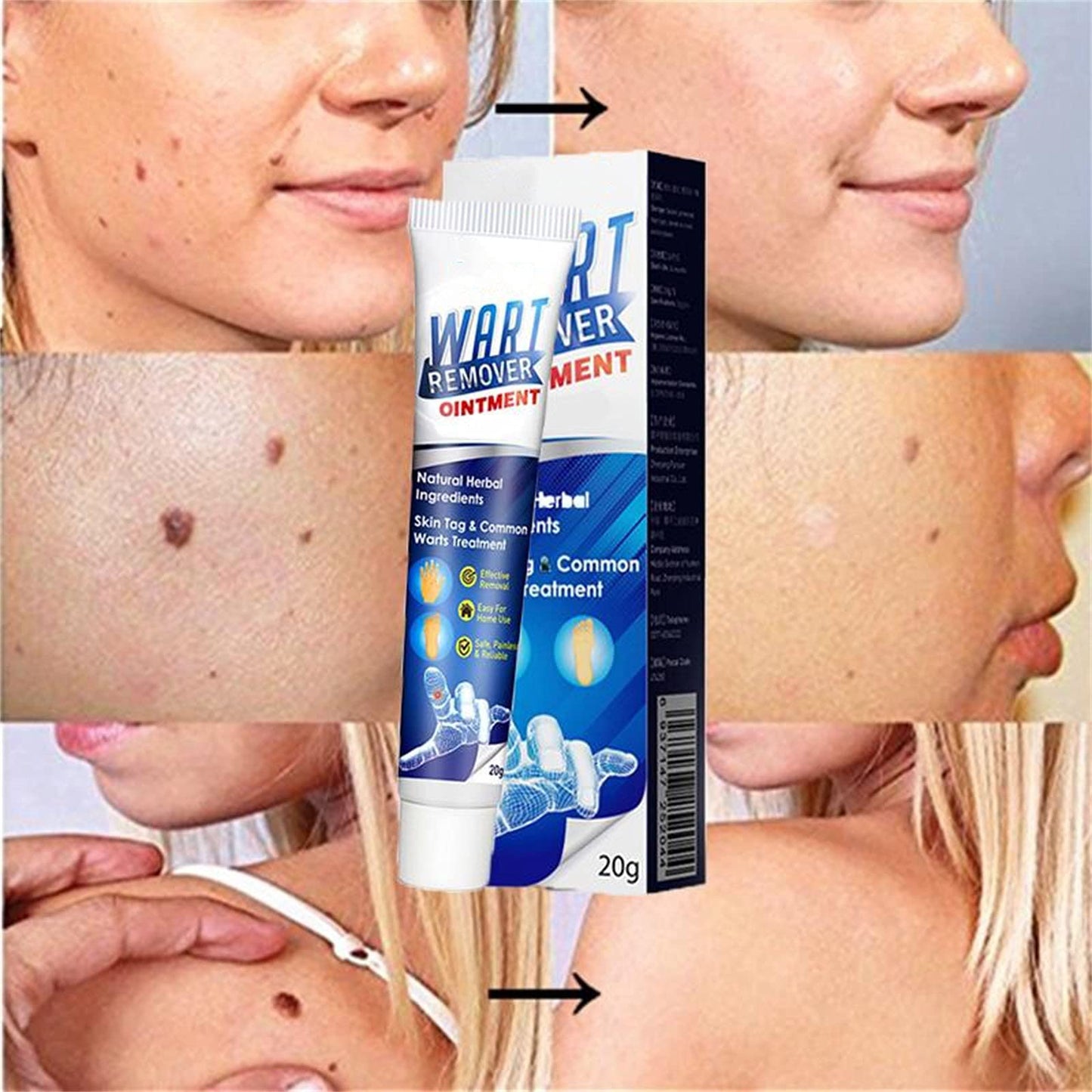 Wart Remover cream