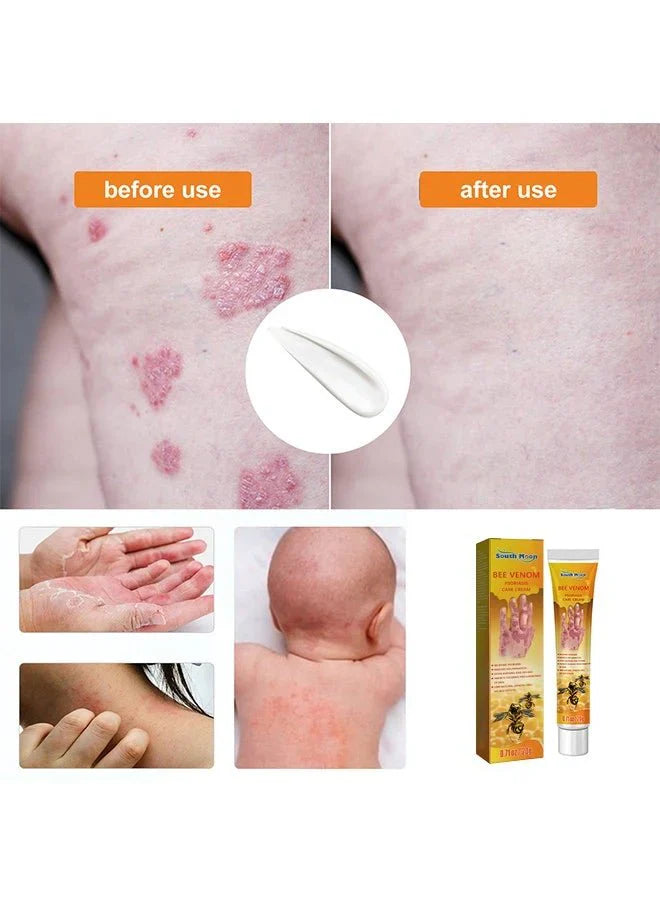 South Moon - Bee Venom Psoriasis Care Cream (Original)