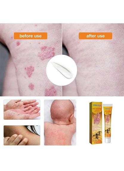 South Moon - Bee Venom Psoriasis Care Cream (Original)