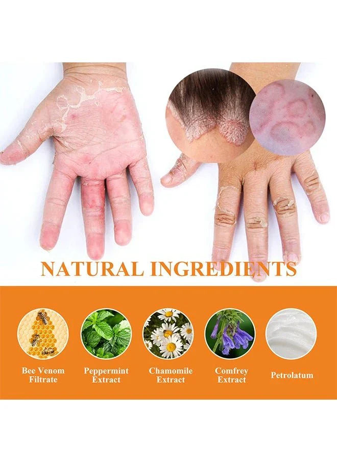 South Moon - Bee Venom Psoriasis Care Cream (Original)